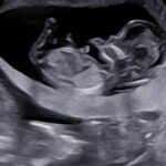 Home nt scan vs nipt which test do you really need for a healthy pregnancy