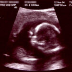 Home obsteric ultrasonograph